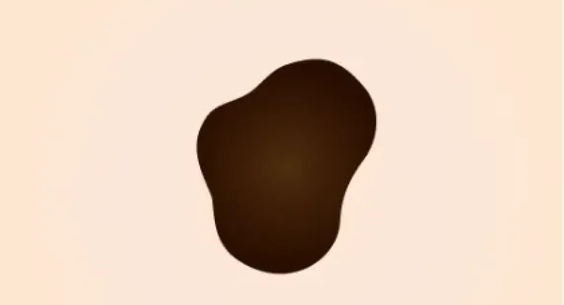 スピッツ母斑
