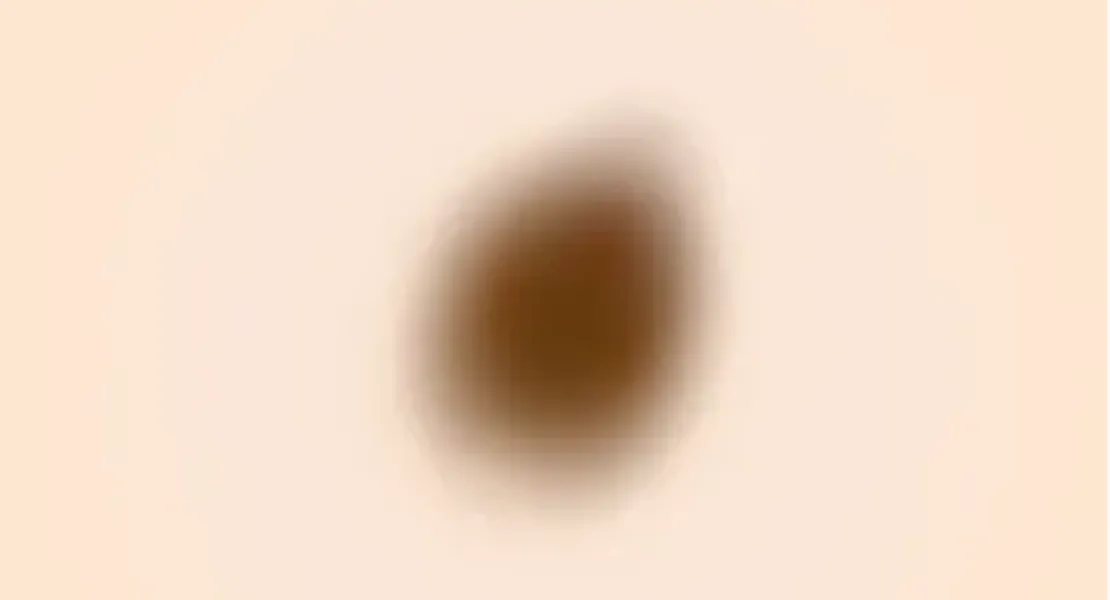 クラーク母斑