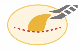指とピンセットで脂肪腫を摘出する図