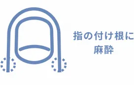 指の付け根にブロック麻酔を行う図