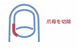 爪母から巻き爪の原因を取り除く図
