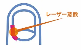 レーザーで爪母を処理する図
